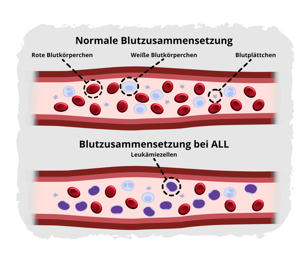 Blutzusammensetzung bei der ALL Schematische Darstellung der Blutzusammensetzung bei gesunden Menschen und bei Menschen mit einer ALL. Im Normalfall sind im Blut drei Blutzelltypen vorhanden: rote Blutkörperchen, weiße Blutkörperchen und Blutplättchen. Bei der ALL verdrängen die Leukämiezellen, entartete unreife weiße Blutkörperchen, zunehmend die gesunden Blutzellen.