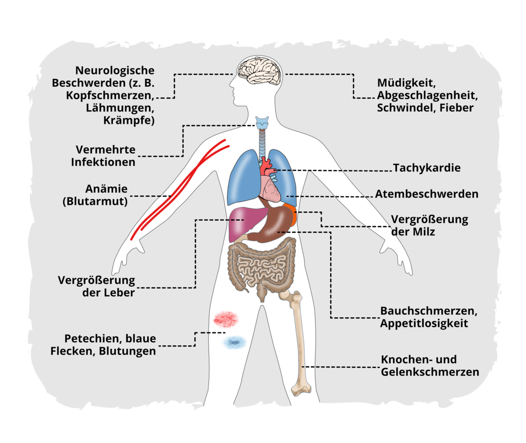 Symptome der ALL Übersicht der Symptome bei der ALL: Schematische Darstellung eines Menschen samt verschiedener innerer Organe. Um ihn herum verschiedene Symptome der ALL genannt: Neurologische Beschwerden (z. B. Kopfschmerzen, Lähmungen, Krämpfe), Müdigkeit, Abgeschlagenheit, Schwindel, Fieber, vermehrte Infektionen, Tachykardie, Anämie (Blutarmut), Atembeschwerden, Vergrößerung der Milz, Vergrößerung der Leber, Bauchschmerzen, Appetitlosigkeit, Petechien, blaue Flecken, Blutungen, Knochen- und Gelenkschmerzen