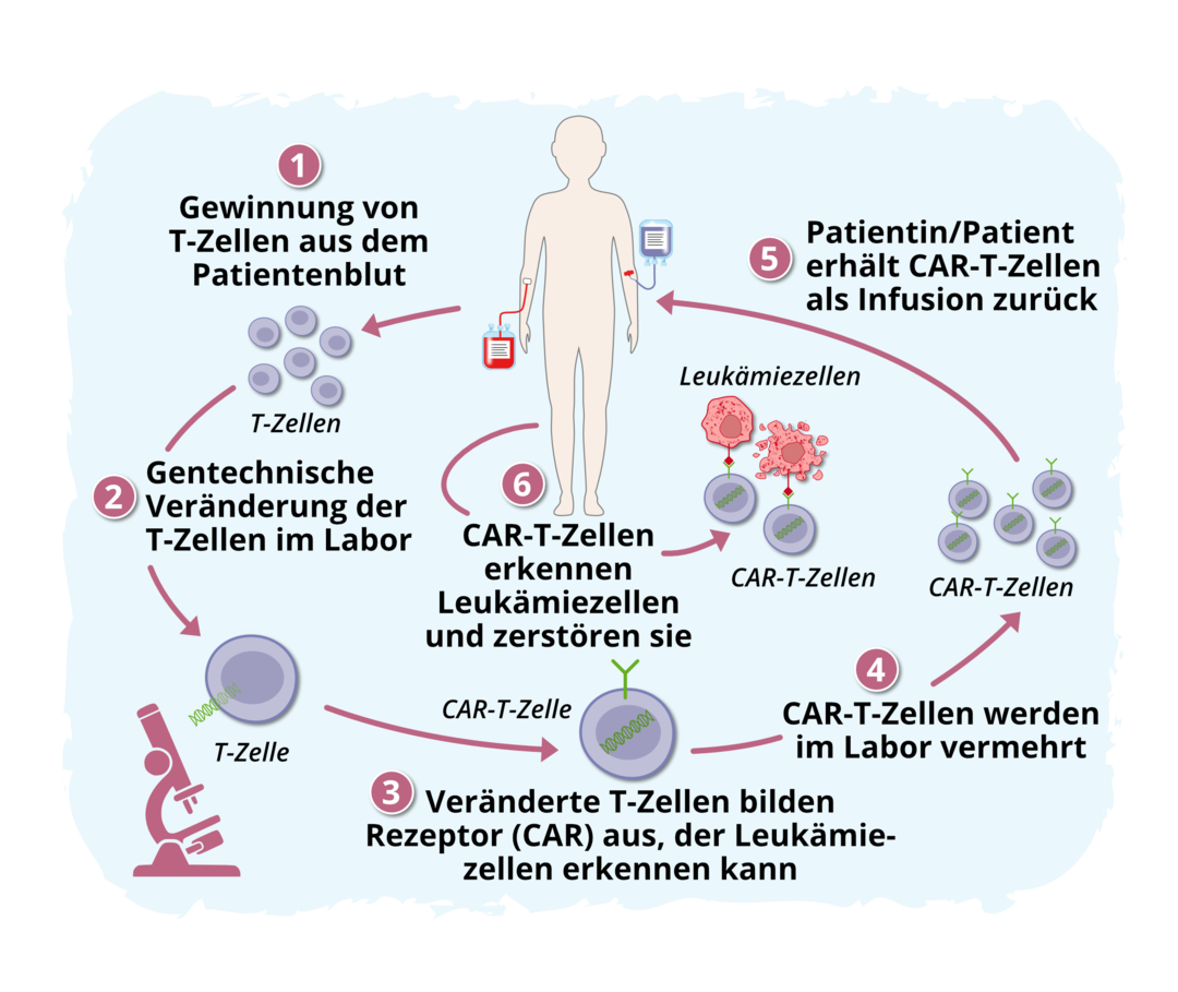 Das Prinzip der CAR-T-Zell-Therapie Schematische Darstellung des Ablaufs der CAR-T-Zell-Therapie: Nachdem T-Zellen aus dem Patientenblut gewonnen wurden, werden sie im Labor gentechnisch so verändert, dass sie einen bestimmten Rezeptor (CAR) ausbilden, der die Lymphomzellen erkennen kann. Die CAR-T-Zellen werden im Labor vermehrt und der Patientin oder dem Patienten als Infusion zurück verabreicht. Sie erkennen nun die Lymphomzellen und zerstören sie.